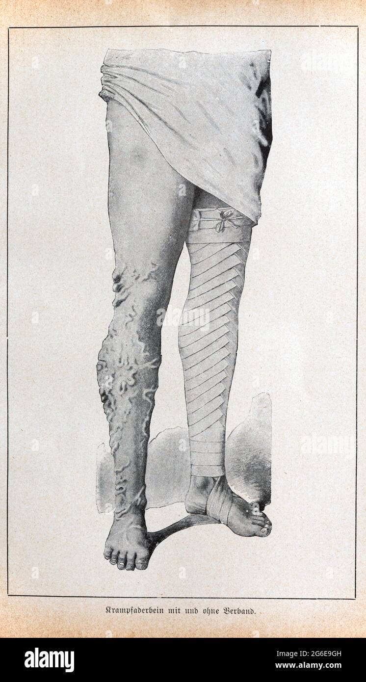Varices (varicose) avec et sans bandages, Der praktische Hausarzt, Ein Weg zur Gesundheit, 1901, Breslau Banque D'Images