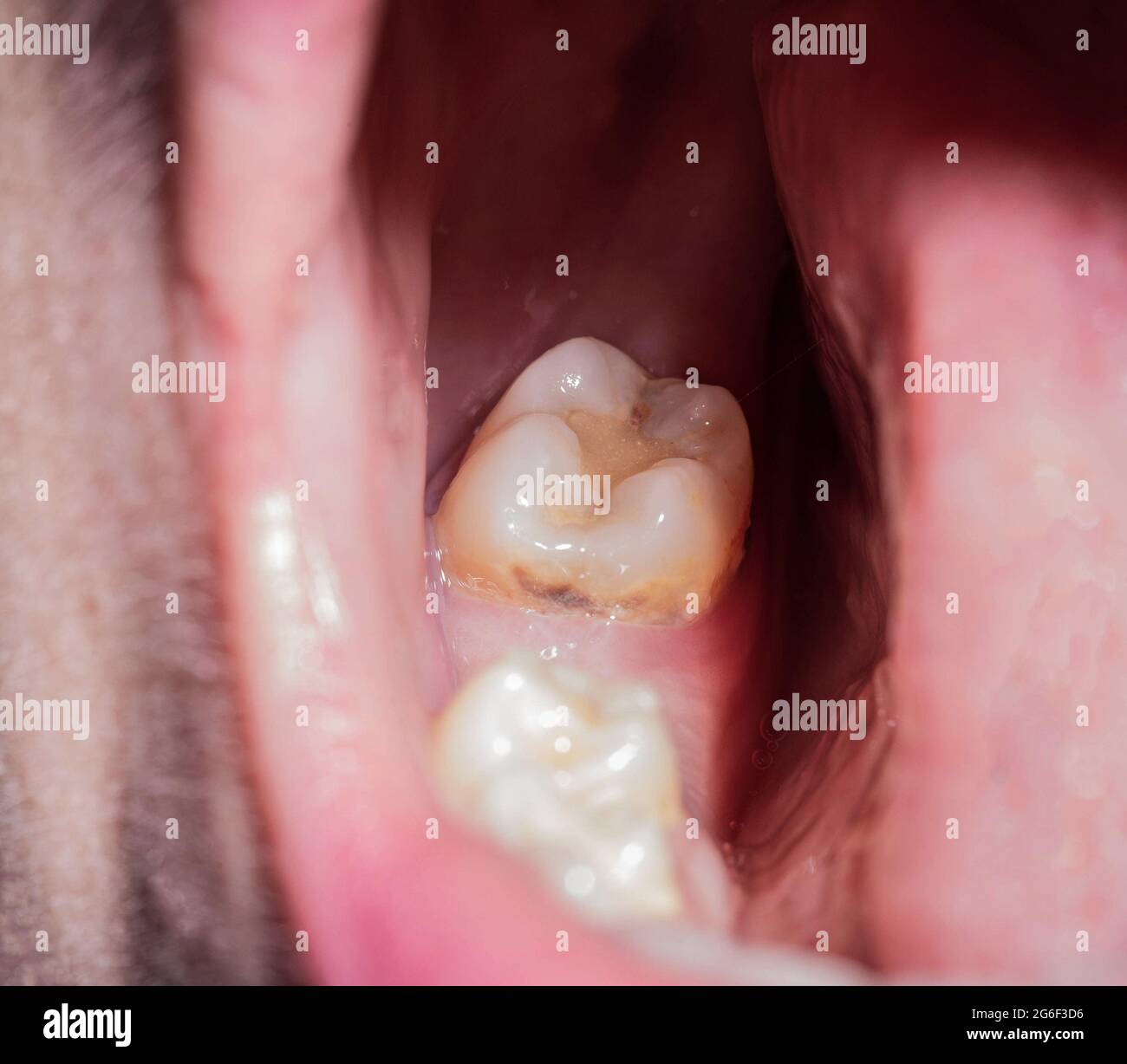 Trou après le retrait d'une dent à mâcher dans la bouche. Cicatrisation des  gencives après extraction dentaire en dentisterie, macro Photo Stock - Alamy