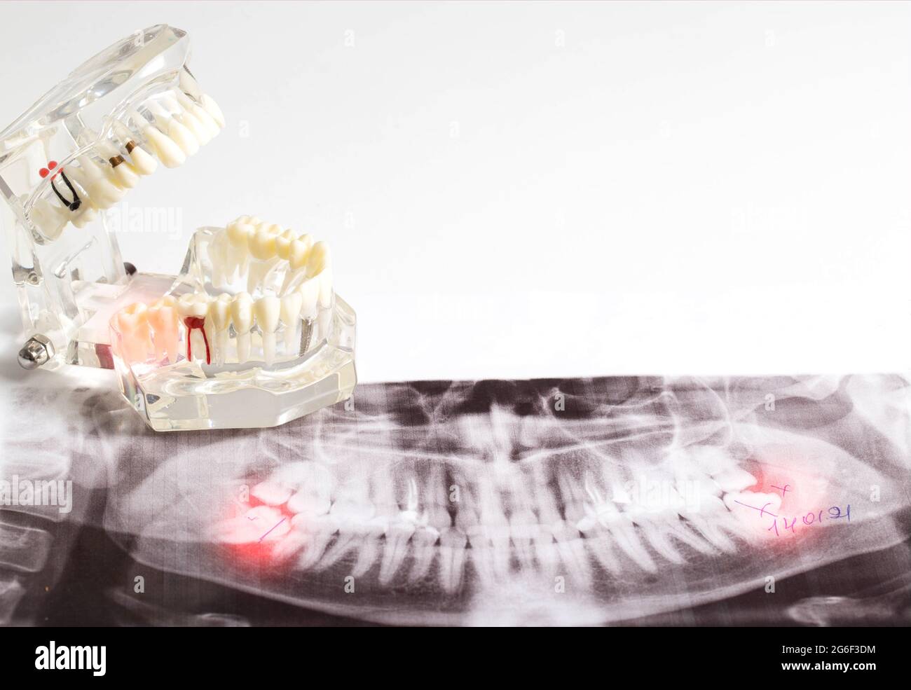 Impact de la sagesse des dents sur une image de rayons X avec un néoplasme de kyste enflammé. Retrait des dents de sagesse en dentisterie Banque D'Images