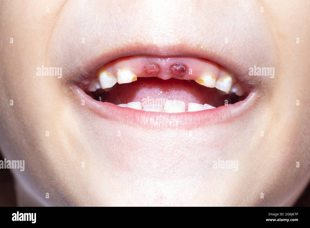 Caries Dentaires Banque D Image Et Photos Alamy