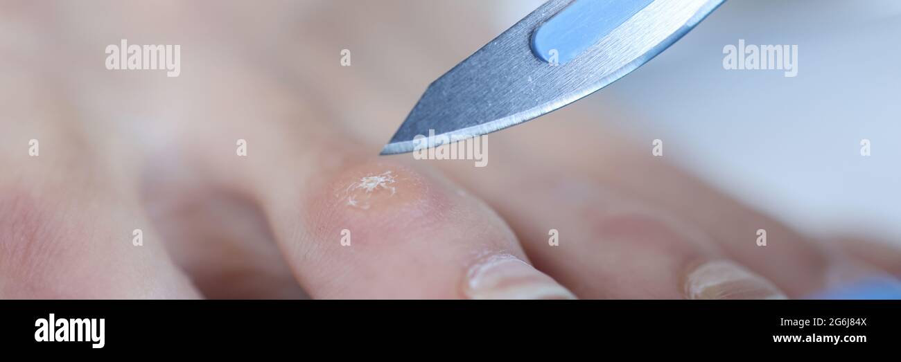 Médecin tenant le scalpel sur le maïs sur la jambe des femmes en gros plan Banque D'Images