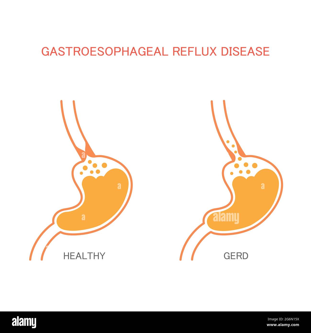 reflux, brûlures d'estomac, douleurs à l'estomac, acide gastrique humain Illustration de Vecteur