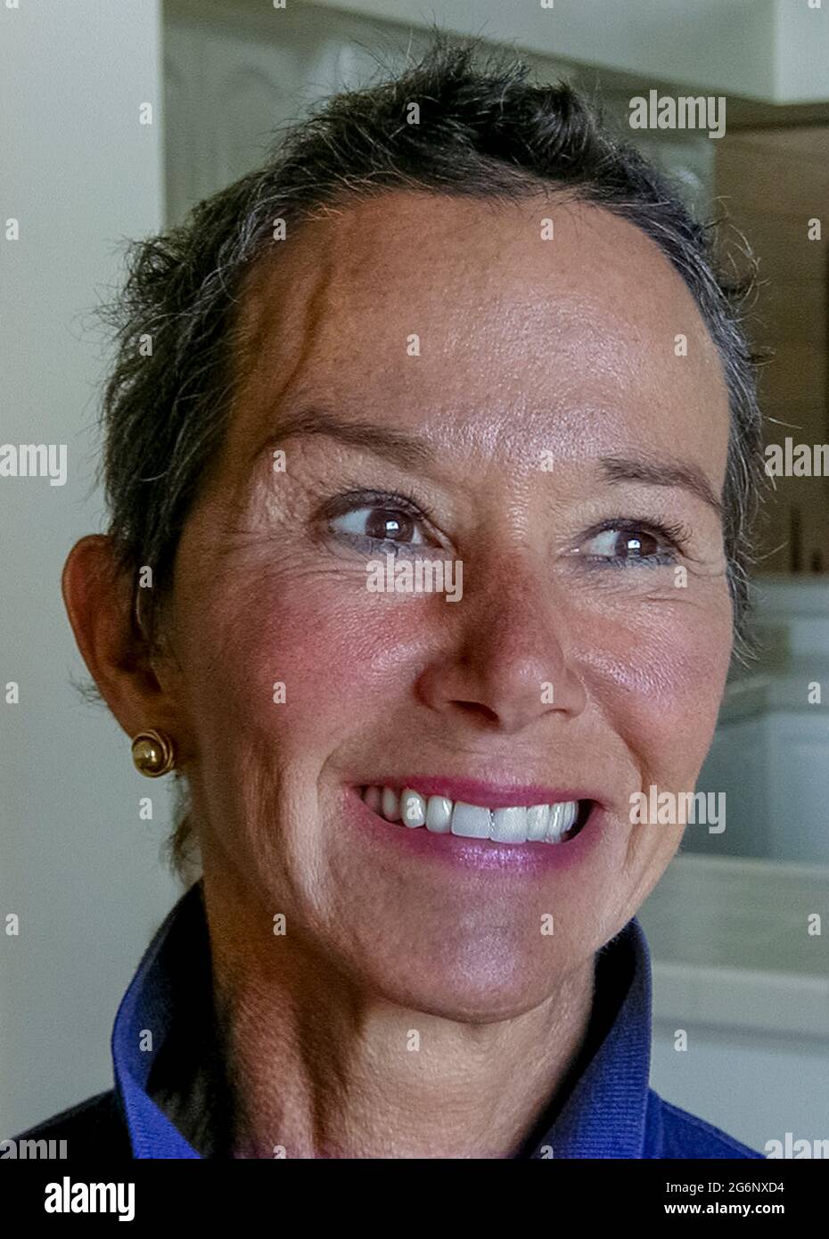 Une femme américaine qui a souffert d'épilepsie fait un sourire heureux  alors que ses cheveux repoussent quelques mois après qu'une incision  importante a été faite dans sa tête lors d'une opération majeure