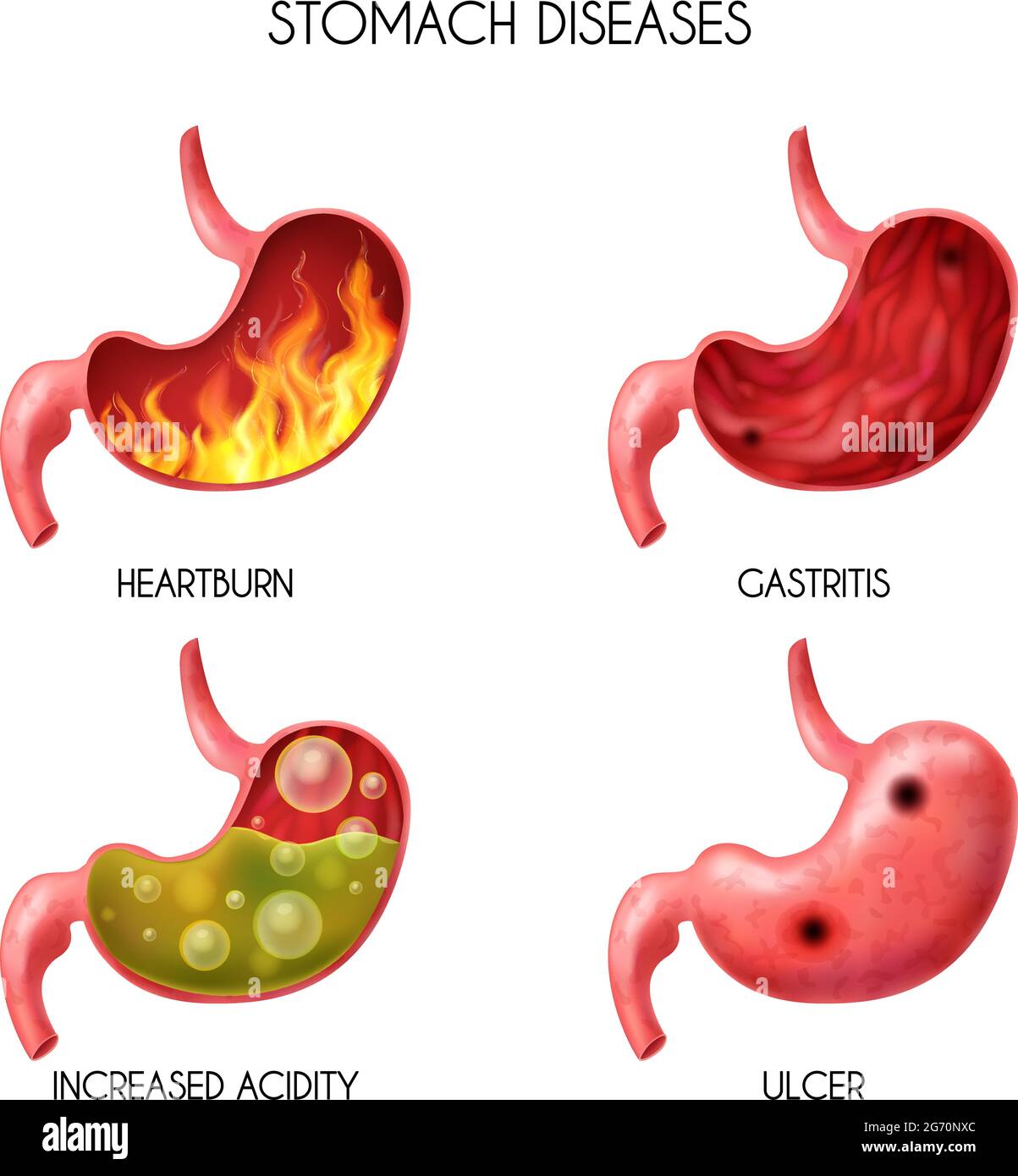 Organe interne humain réaliste icône d'estomac ensemble pyrose feu trouble gastrique reflux gastrique boule ballmée abdominale illustration vectorielle de la nausée Illustration de Vecteur