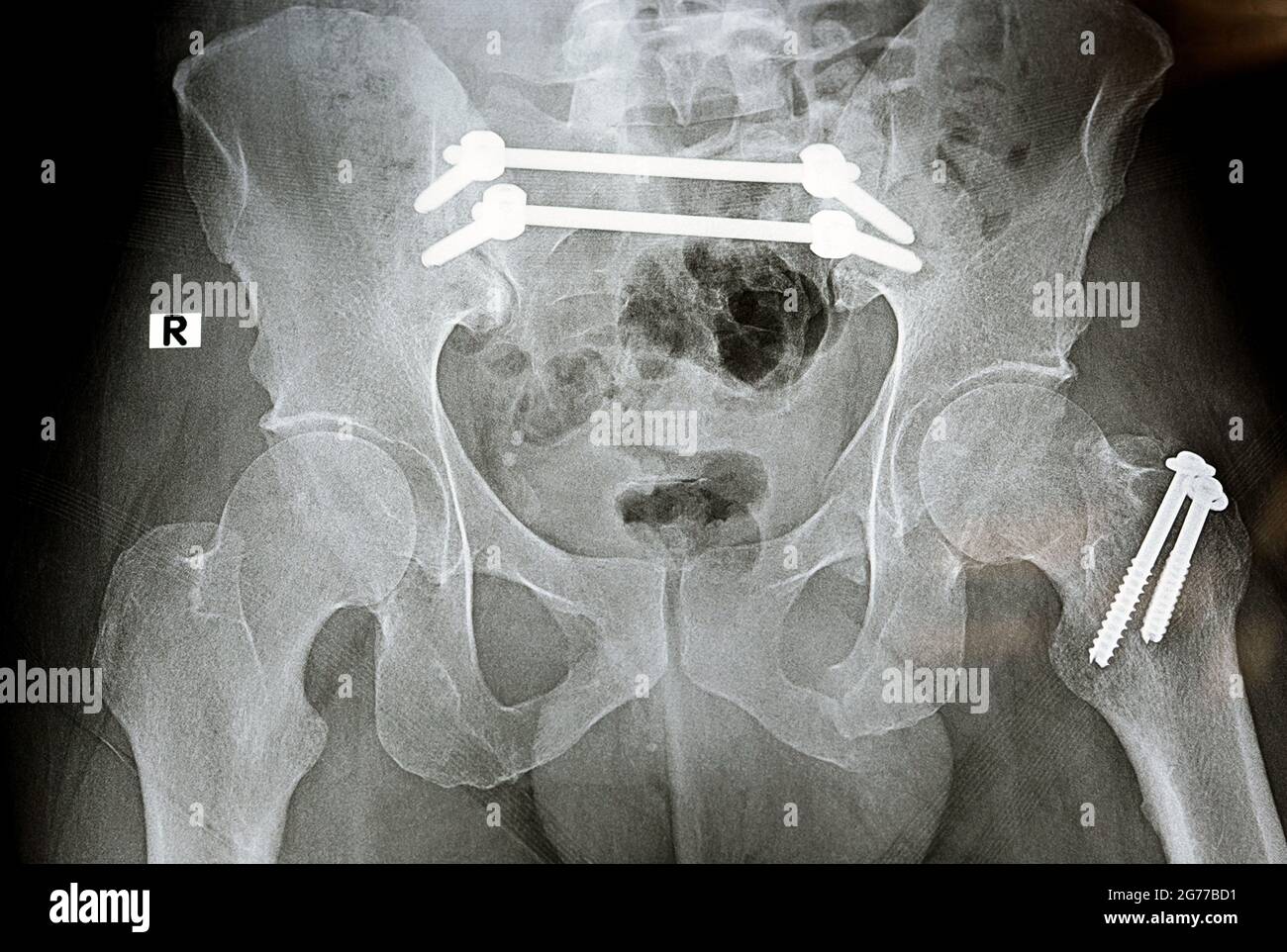 Rayon X simple avec une fracture pelvienne qui est fixé avec 4 vis et 2 tiges et fracture du grand trochanter du fémur fixé avec 2 vis Banque D'Images