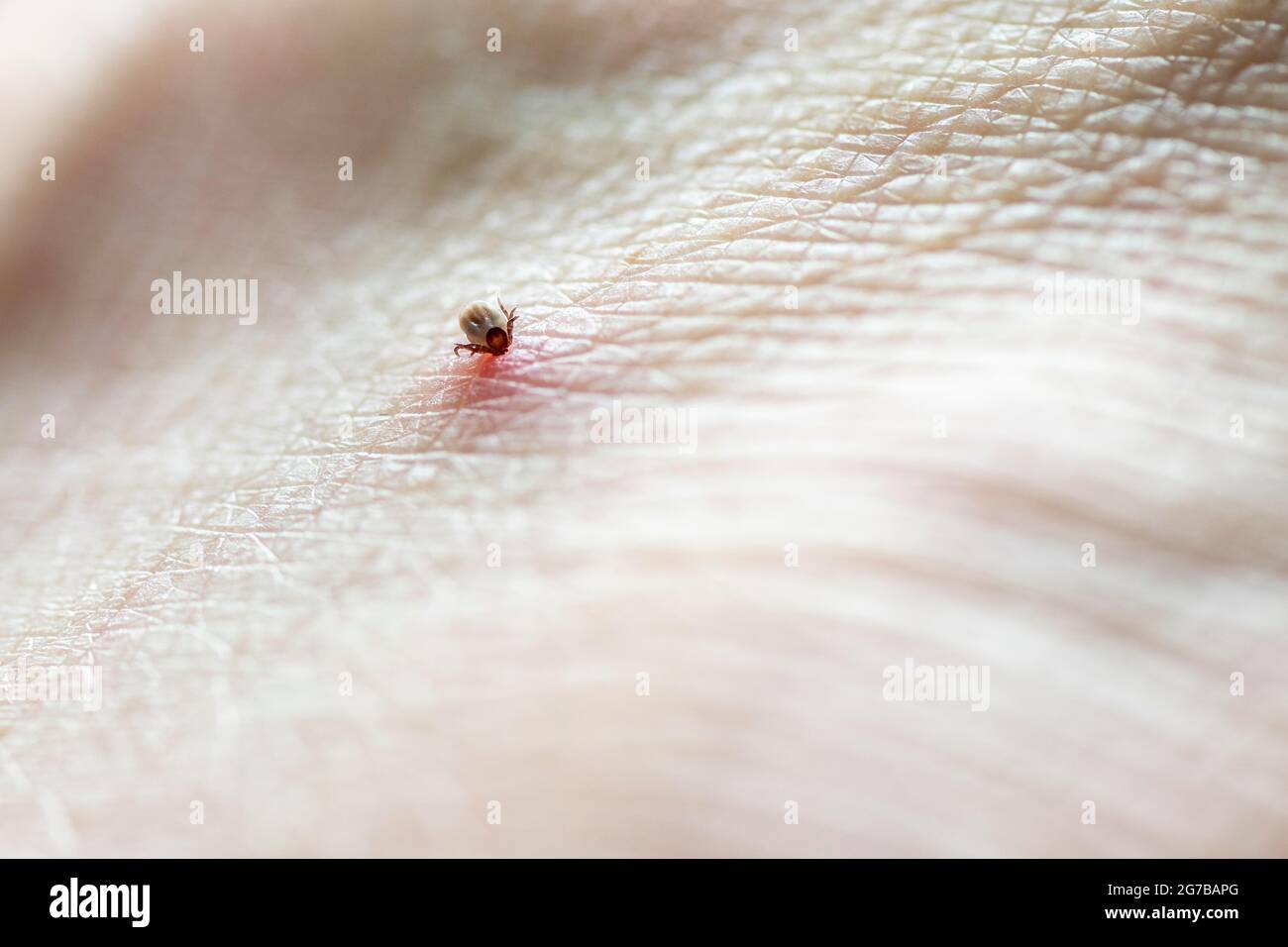 Ricin haricot Tick (Ixodes ricinus), tique sur la peau humaine, morsure de tique Banque D'Images