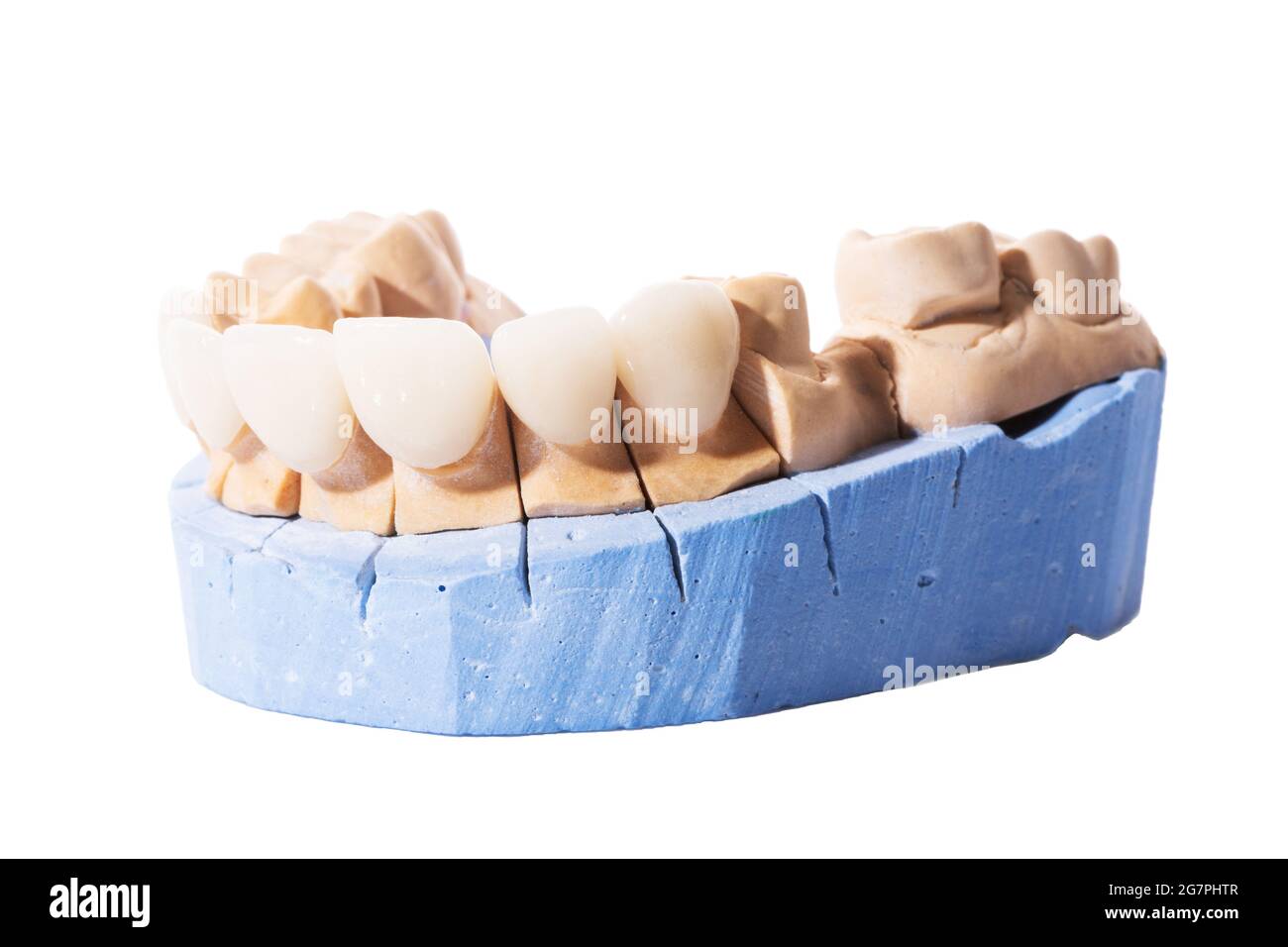 Boiseries et couronnes isolées sur fond blanc. Modèle de plâtre de dents. Modèle de plâtre à mâchoire inférieure avec dents préparées. Plâtre démontable de travail Banque D'Images