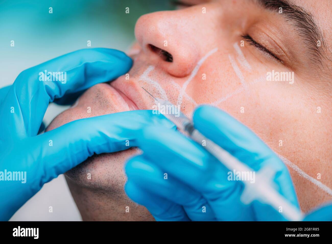 Traitement de beauté par remplissage dermique Banque D'Images