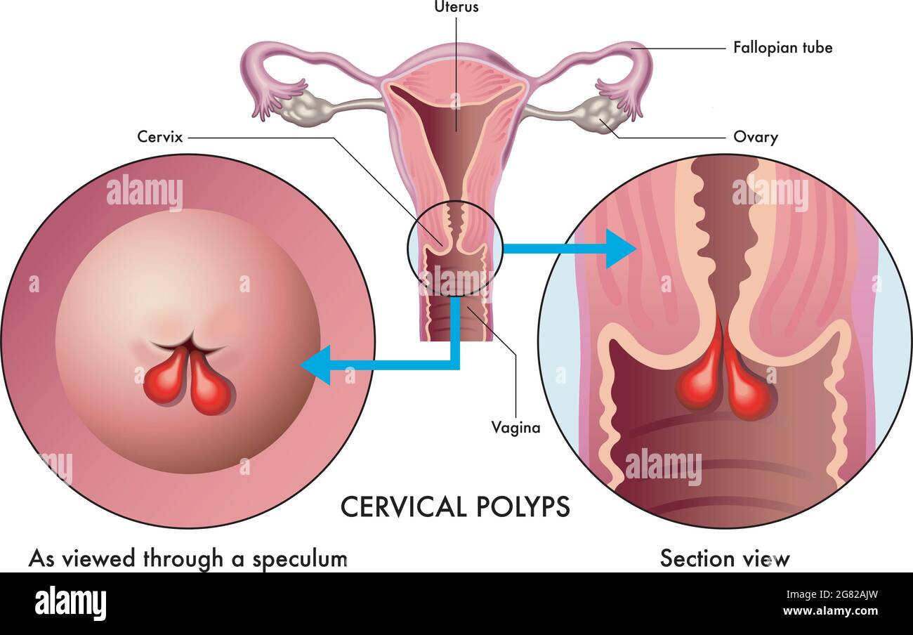 L'illustration médicale montre un système reproducteur féminin avec polypes cervicaux, avec des annotations. Illustration de Vecteur