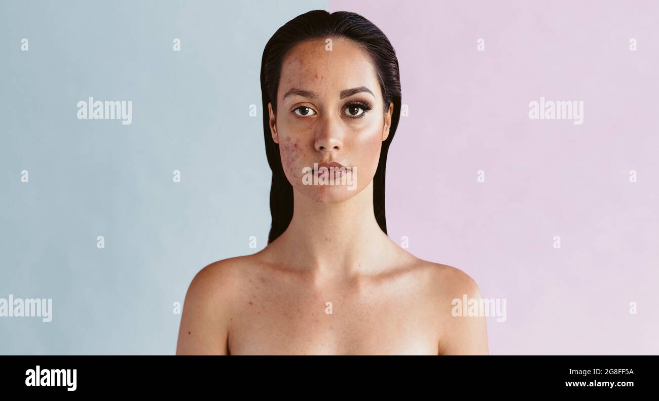 Portrait de la femme montrant l'acné sur la moitié du visage et la peau claire en utilisant le maquillage sur l'autre moitié. Contraste avant et après maquillage visage d'une femme avec ac Banque D'Images