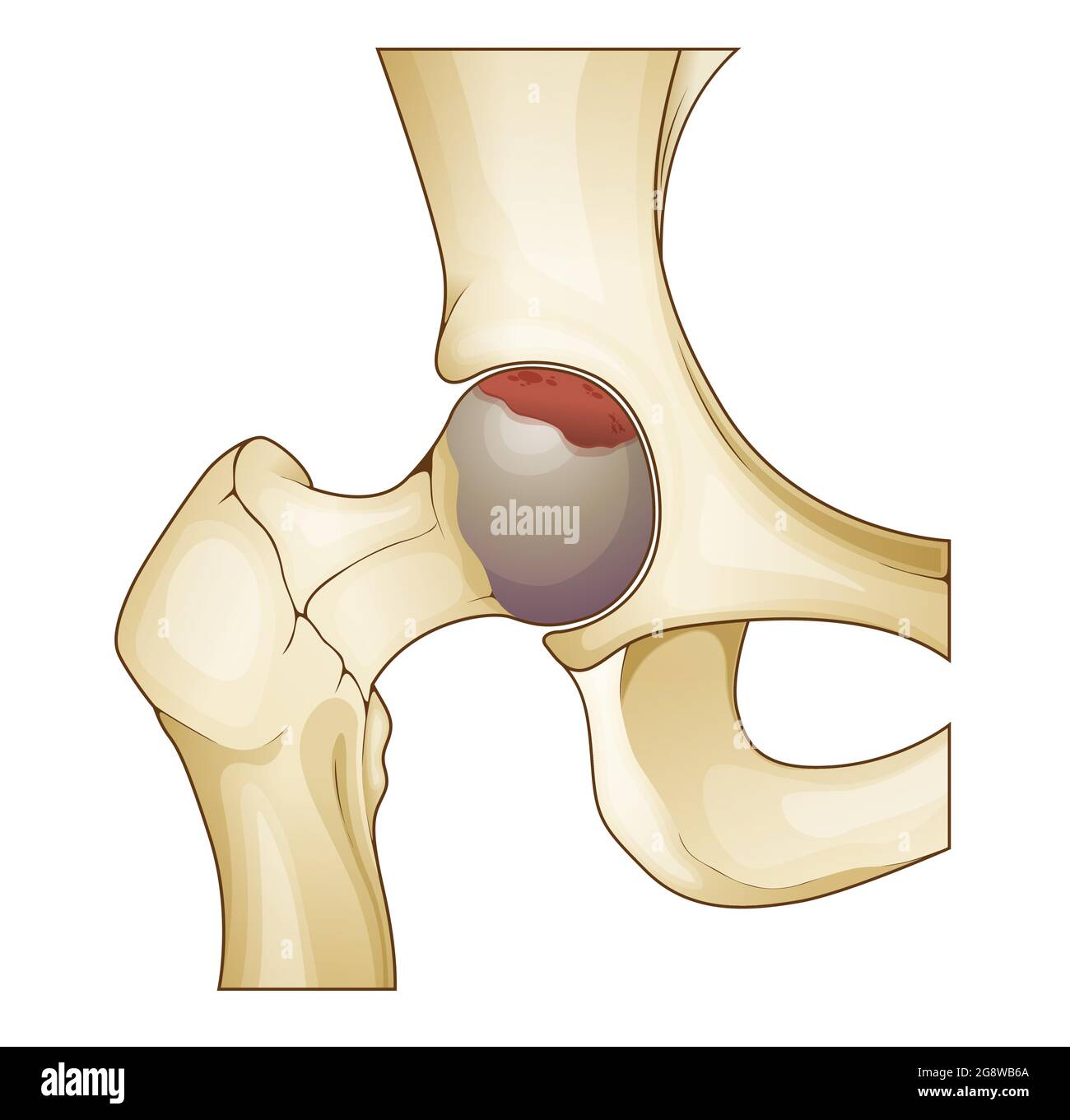 Arthrose - mort osseuse - articulation de la hanche - Illustration de stock comme fichier EPS 10 Illustration de Vecteur