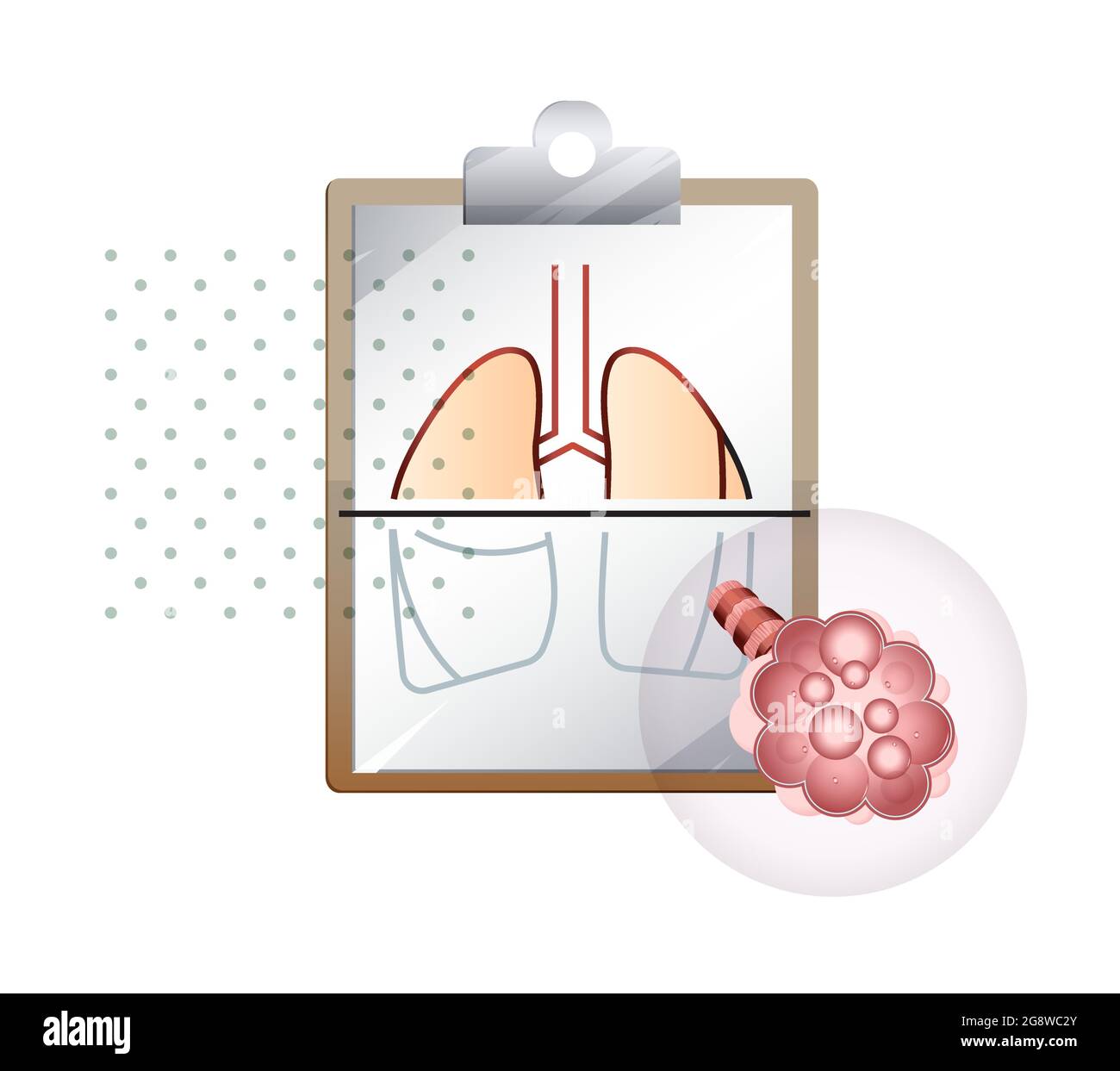 Covid-19 impact sur les poumons humains - ŒDÈME PULMONAIRE - Illustration du fichier EPS 10 Illustration de Vecteur