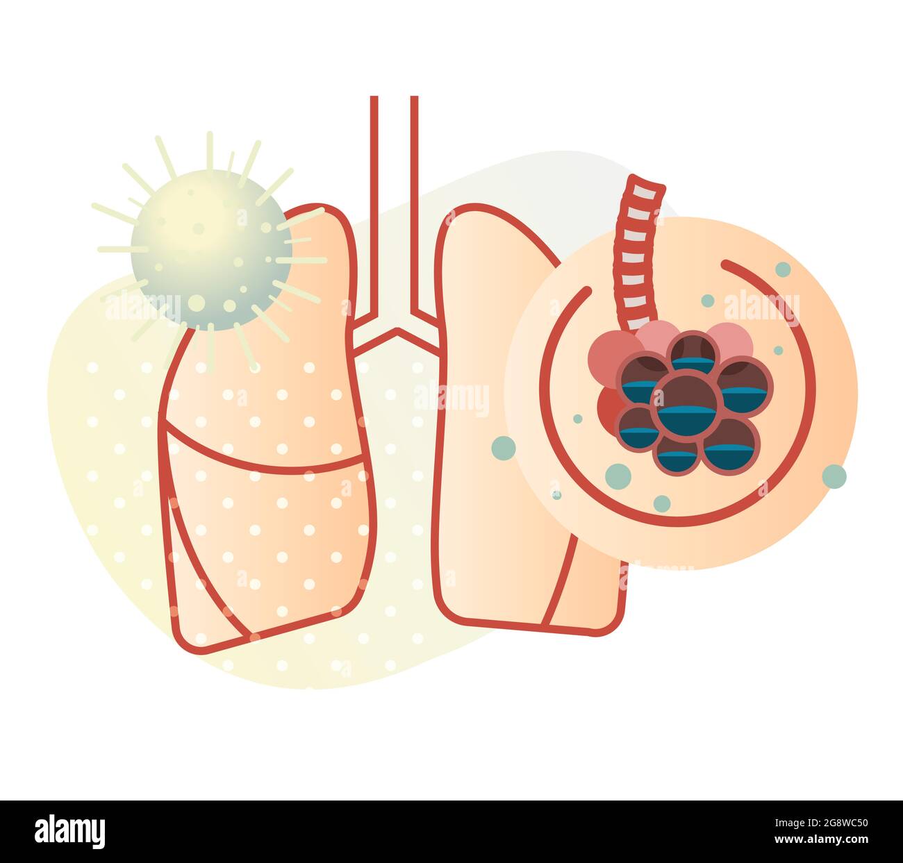Covid-19 impact sur les poumons humains - ŒDÈME PULMONAIRE - Illustration du fichier EPS 10 Illustration de Vecteur