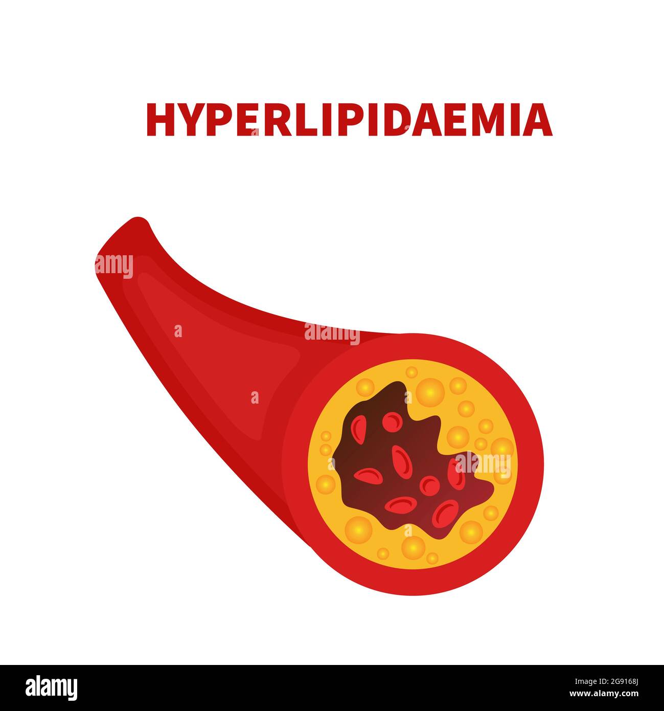 Hyperlipidémie, illustration conceptuelle Banque D'Images