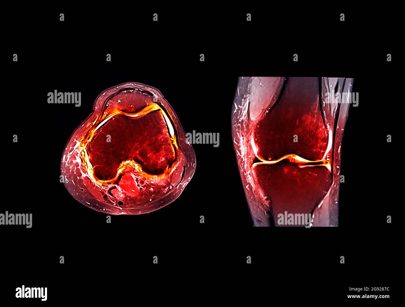 Imagerie par résonance magnétique ou comparaison des articulations du genou par IRM vue frontale et sagittale pour détecter la déchirure ou l'entorse du ligament croisé antérieur (ACL) Banque D'Images