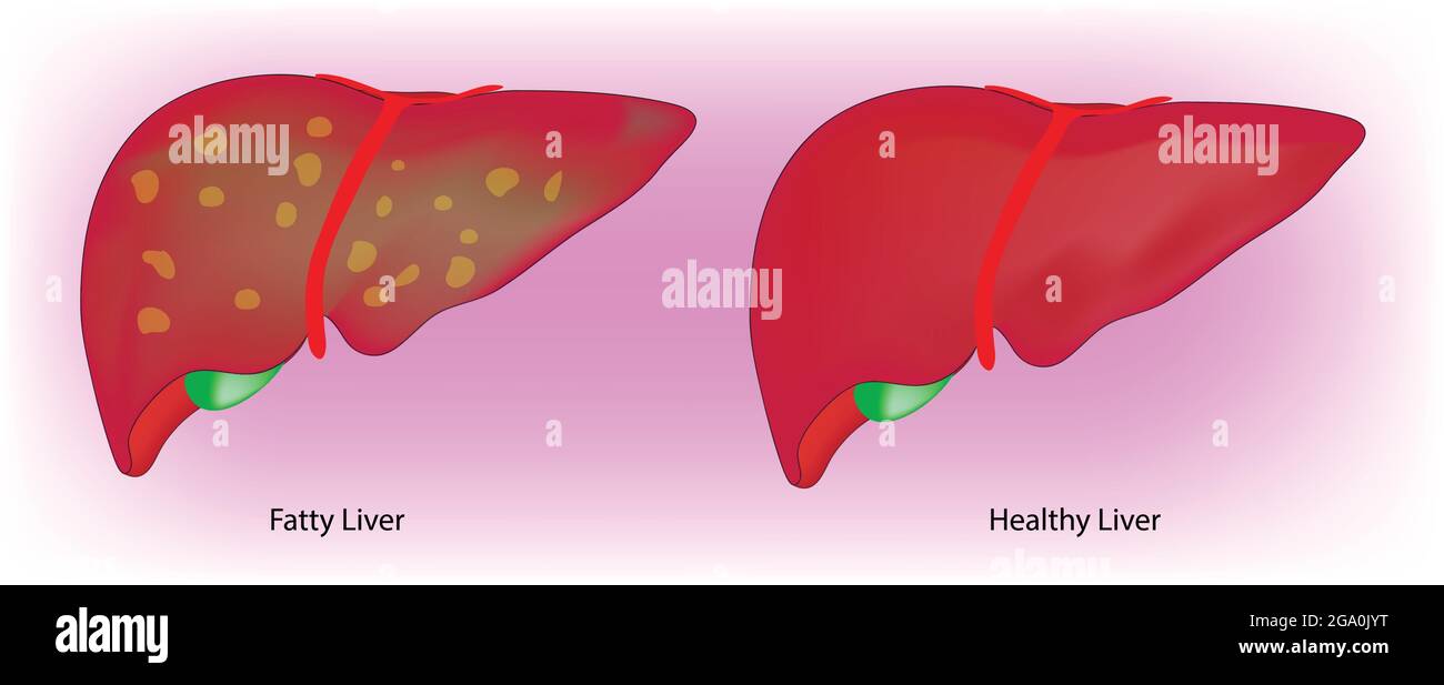 Illustration biologique du foie gras et du foie sain stéatose