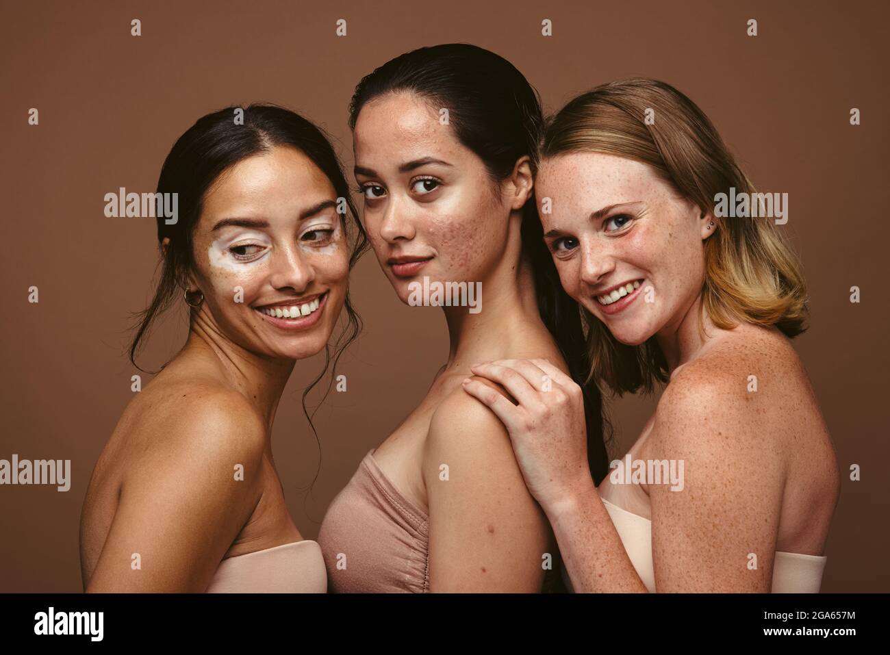 Les jeunes femmes ayant divers problèmes de peau debout ensemble sur fond marron. Portrait de trois jeunes femmes avec des problèmes de peau représentant l'auto acc Banque D'Images