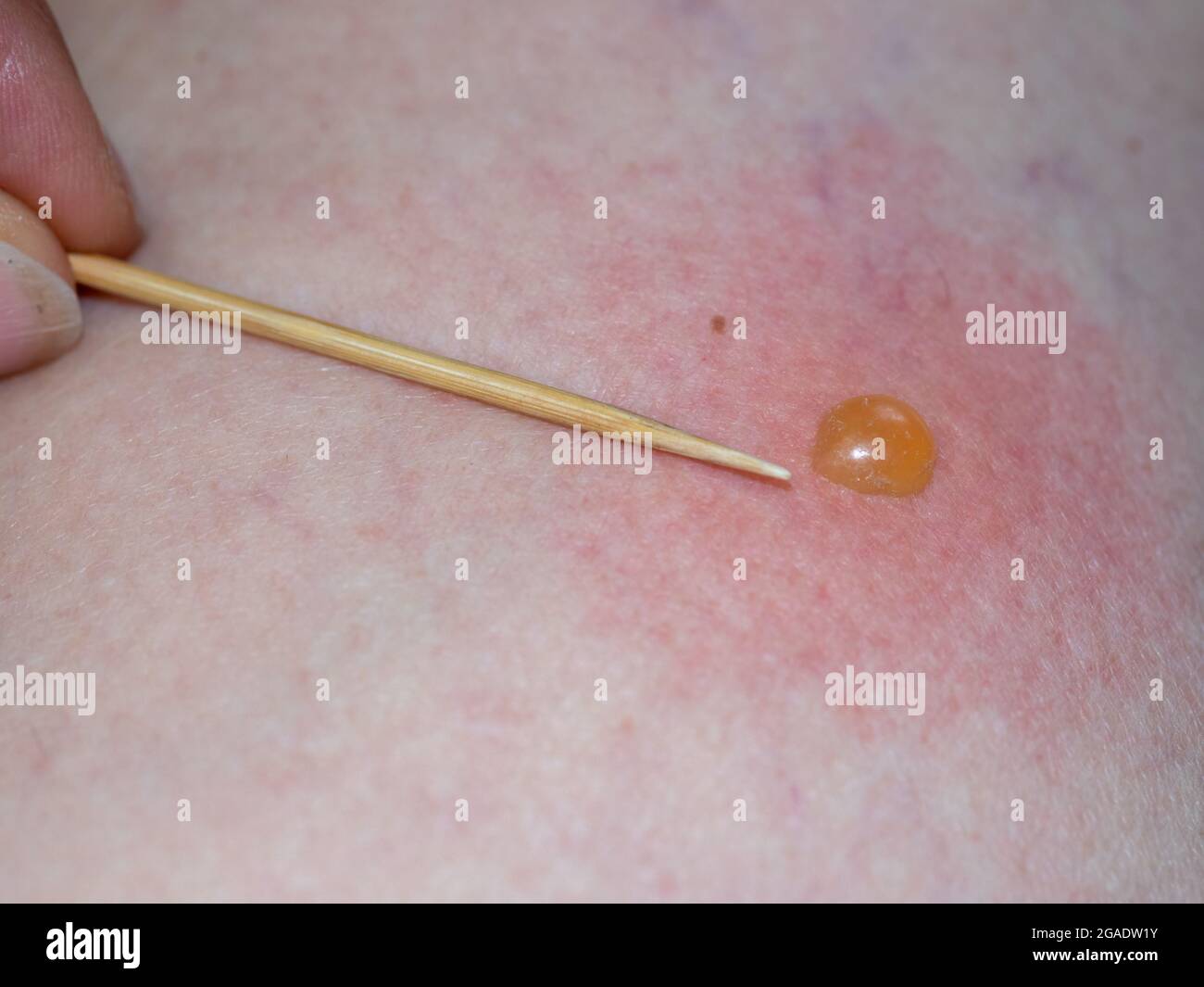 Piqûre d'insecte sur la peau avec une plaquette thermoformée. Banque D'Images