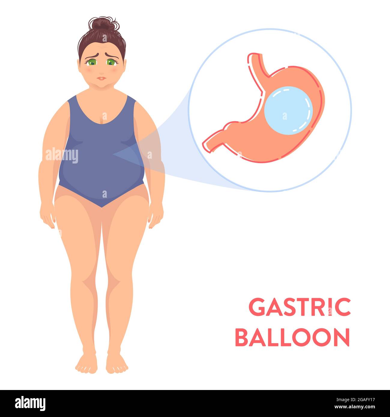 Ballon gastrique, illustration conceptuelle Banque D'Images