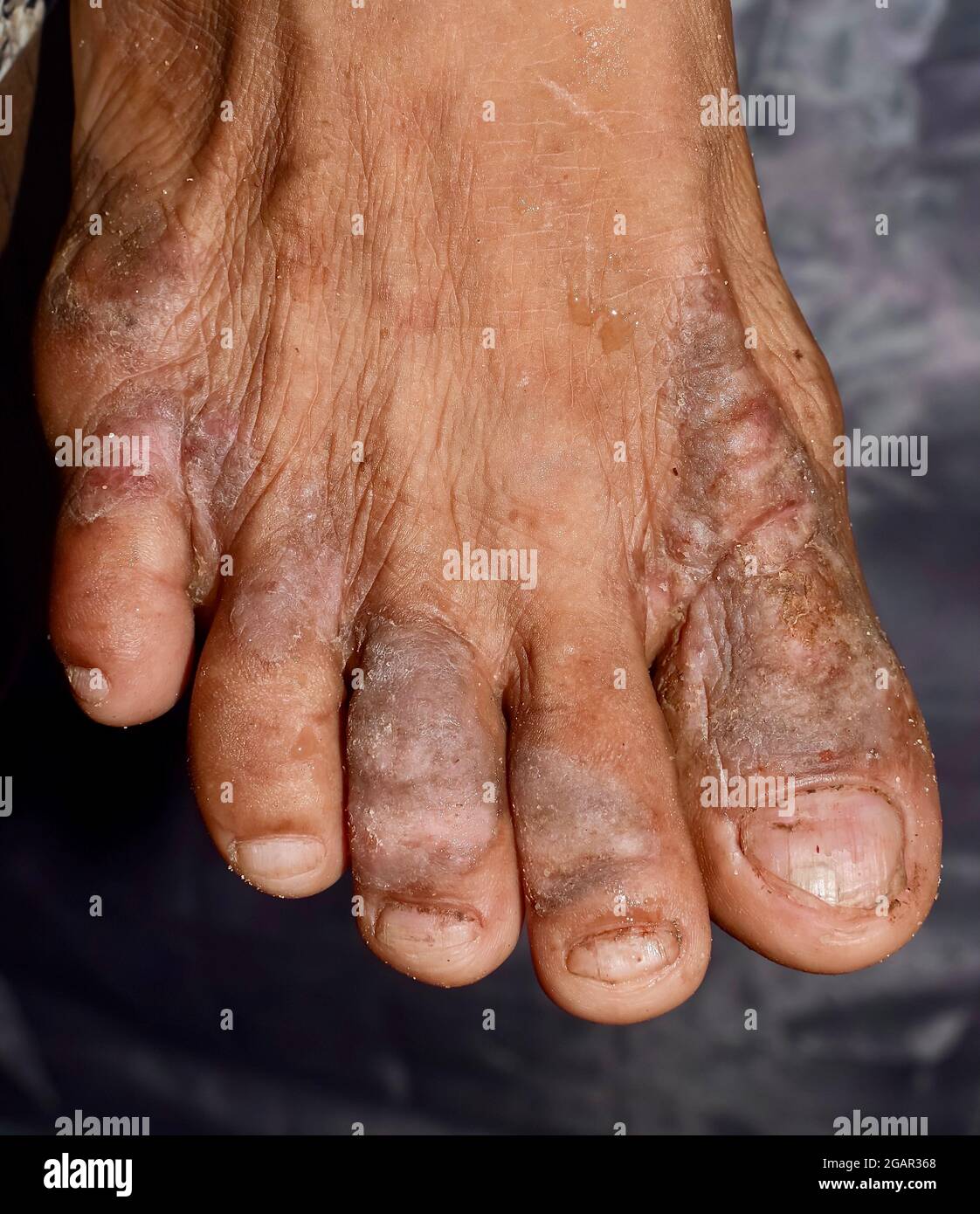 Eczéma ou infection fongique au pied de l'homme asiatique. Vue en gros plan. Banque D'Images