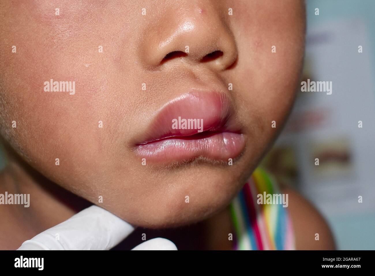 Œdème de Quincke sur les lèvres de l'enfant mâle d'Asie du Sud-est. Enfant édémateux. Causée par une allergie aux médicaments, aux fruits de mer ou aux produits chimiques et par des piqûres d'insectes. Vue latérale. Banque D'Images