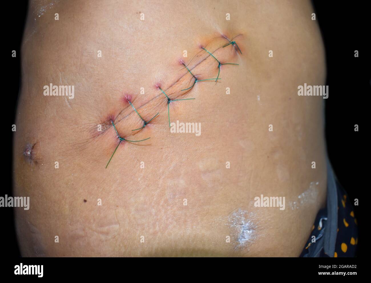 Incision de Kocher ou incision sous-costal ou oblique pour une cholécystectomie ouverte. Plaies ou points de suture infectés. Il est également fait pour la chirurgie du foie et de la bili Banque D'Images