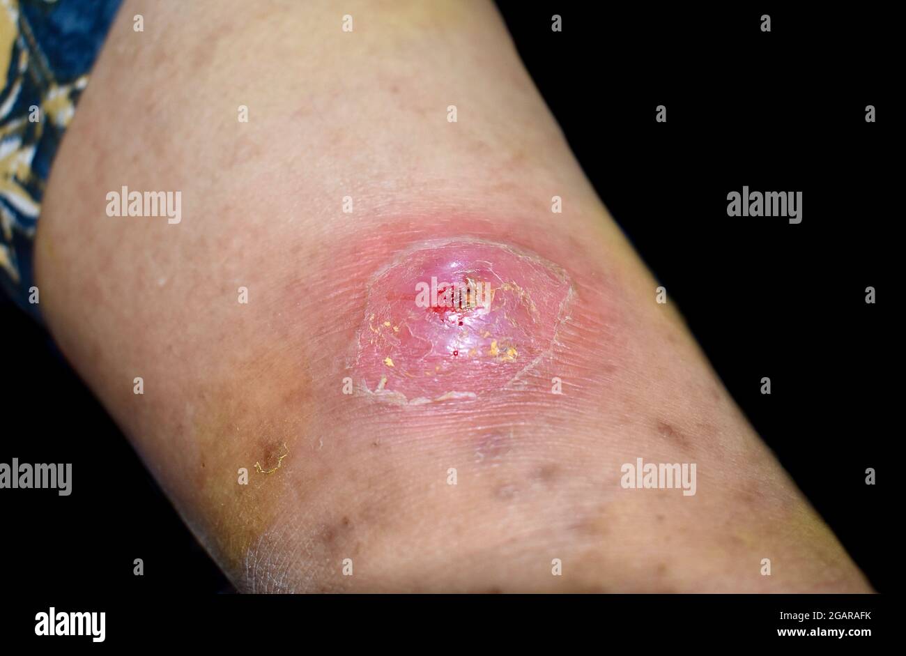 Abcès imminent avec cellulite environnante ou infection cutanée  staphylococcique/streptococcique dans la jambe droite du patient birman  asiatique. Vue latérale. Est Photo Stock - Alamy