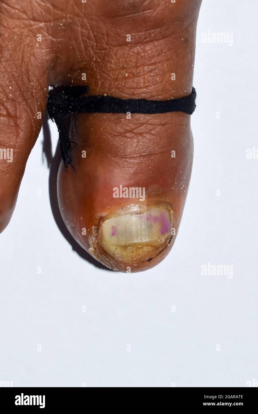 pied d athlète ongle