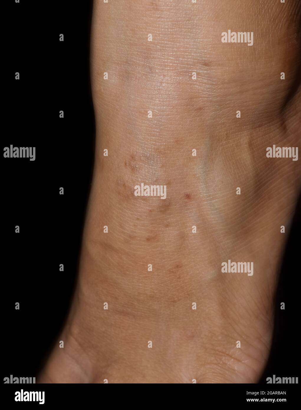 Molluscum contagiosum Banque de photographies et d’images à haute résolution Alamy