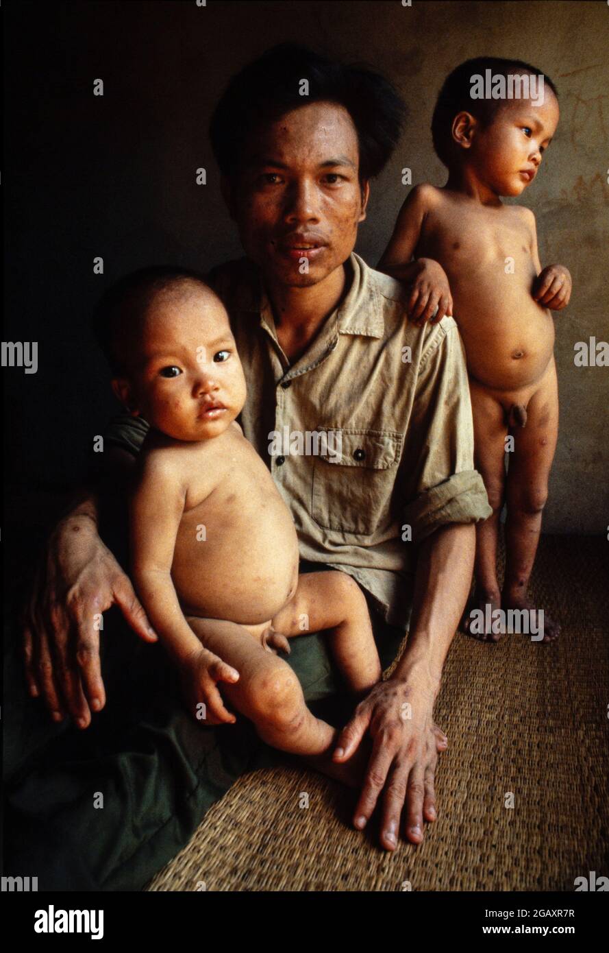 Ce père, un soldat sur le sentier de Ho Chi Minh, a été aspergé directement avec l'agent Orange. Ses deux fils ont tous deux des défauts cardiaques, juin 1980. Banque D'Images