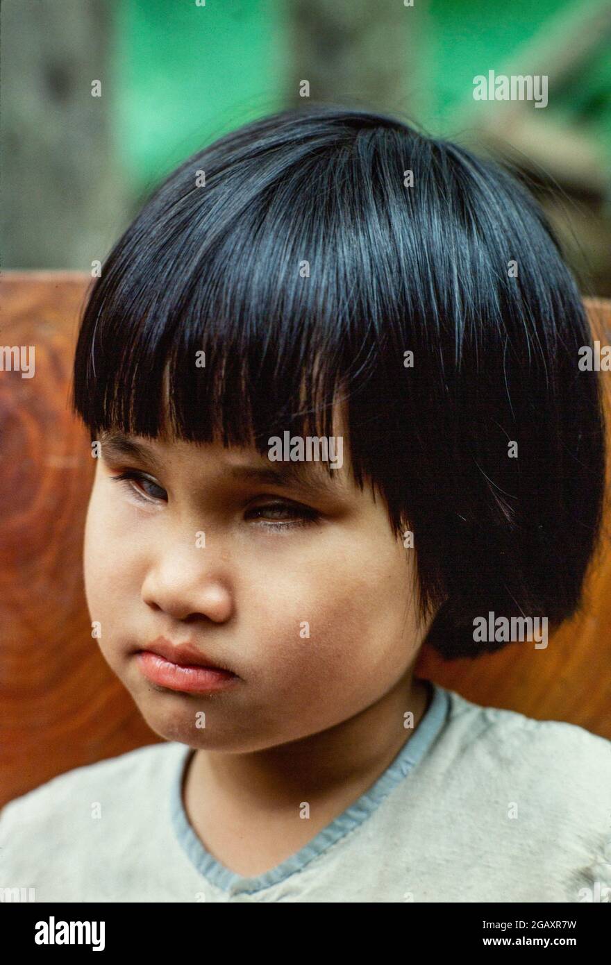 Hien, 6 ans, est né après que leur père ait été aspergé pendant la guerre du Vietnam avec l'agent Orange par des avions américains. Elle est née avec des lentilles dans ses yeux. Banque D'Images