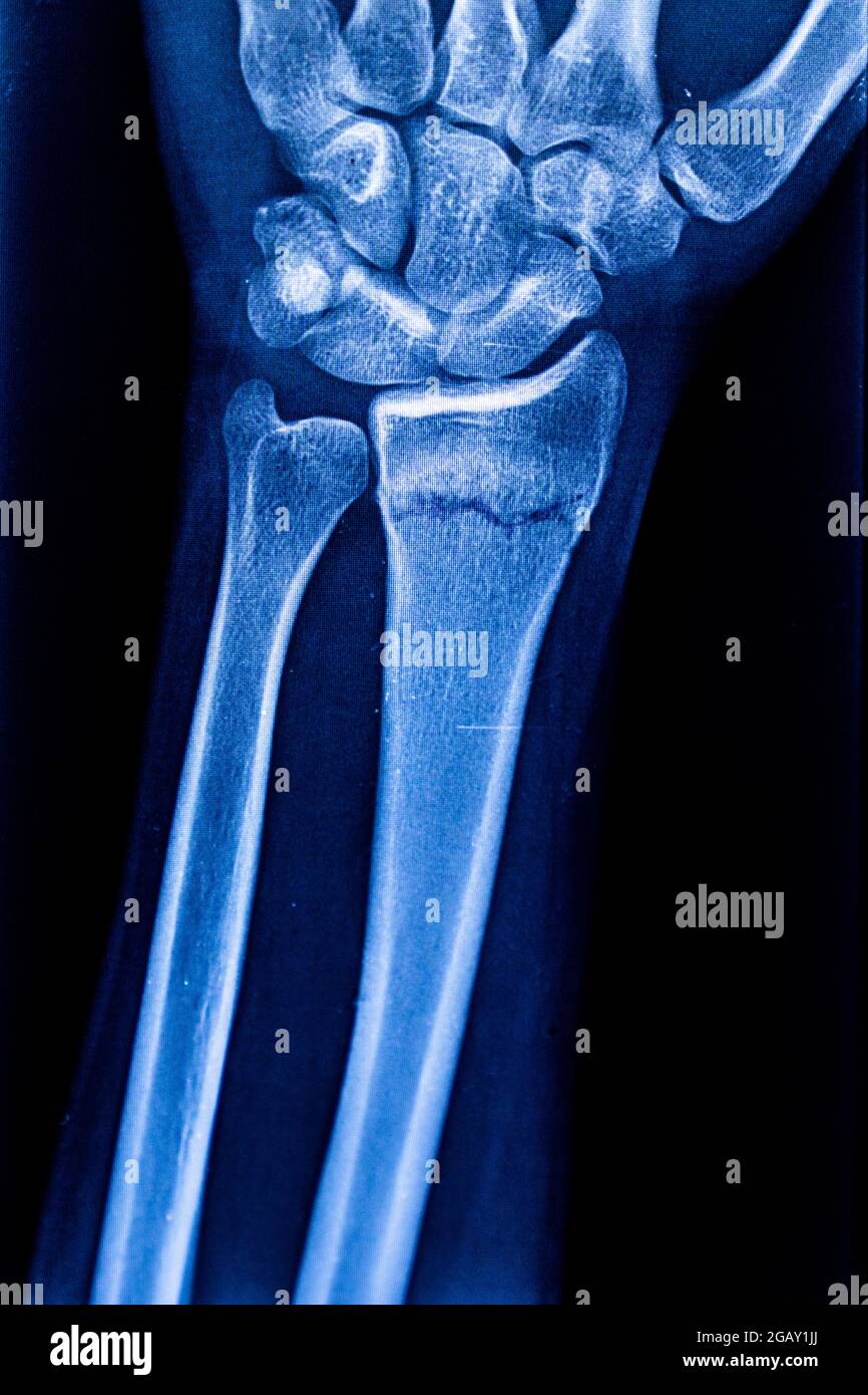 Radiographie du bras Banque de photographies et d'images à haute résolution  - Alamy