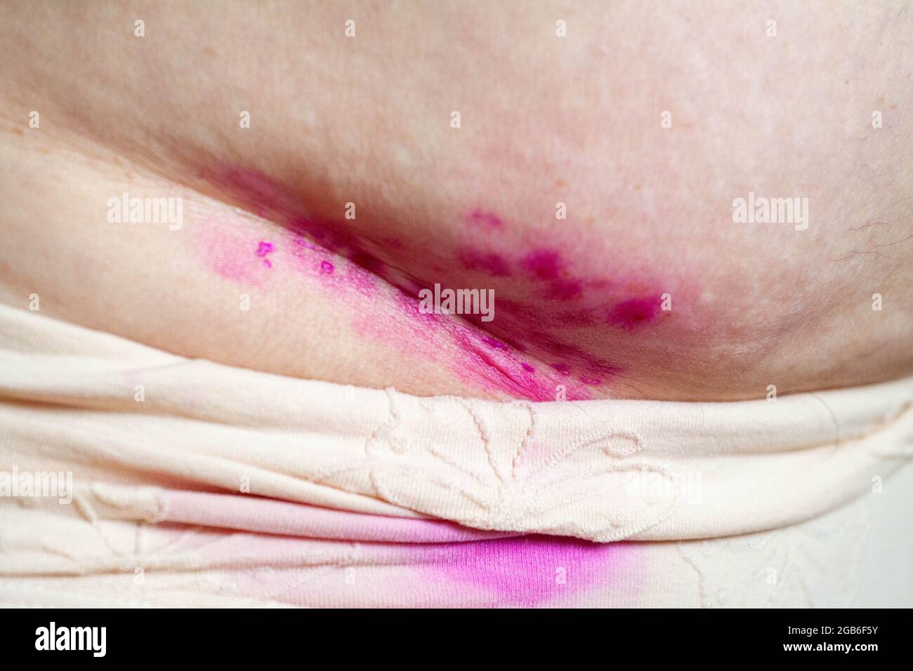 Coutures chirurgicales, suture au niveau de l'abdomen. Une blessure sur l'abdomen d'une personne. Lésion cutanée traitée avec une onguent antiseptique et médicinal. Banque D'Images