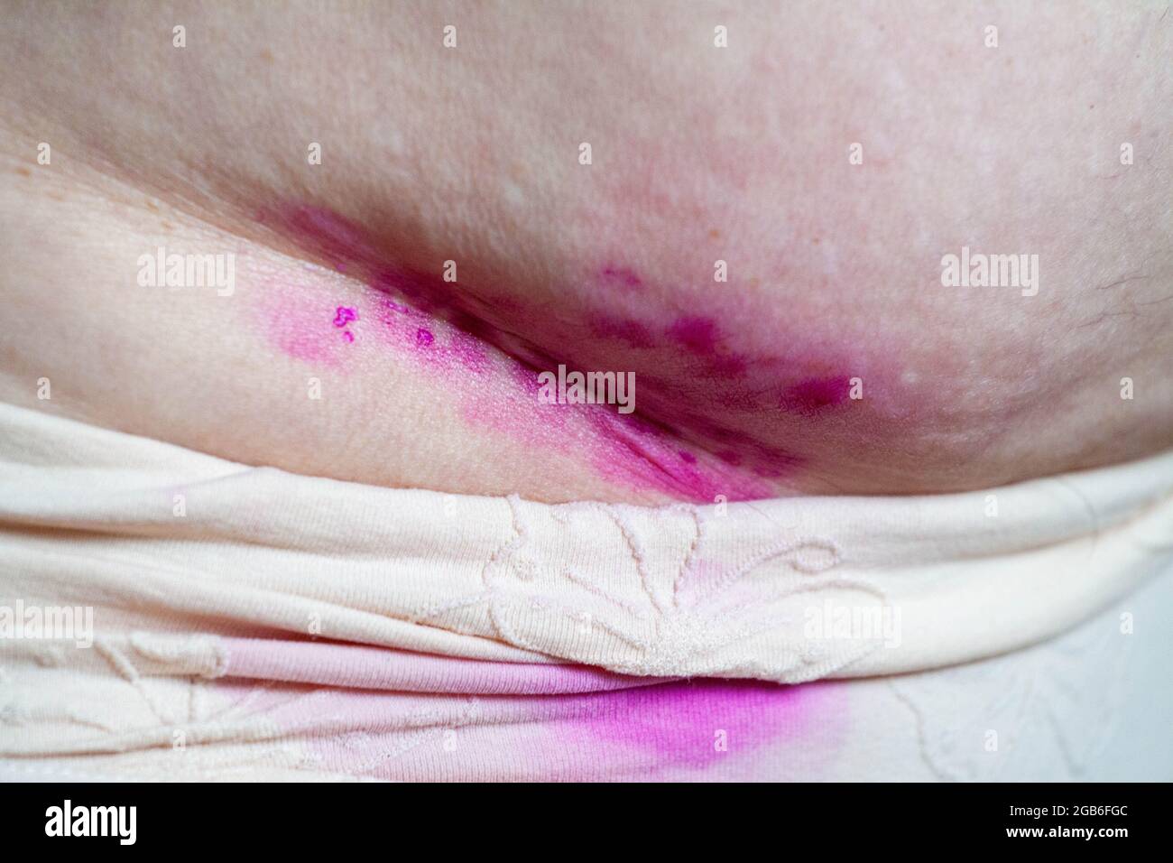 Coutures chirurgicales, suture au niveau de l'abdomen. Une blessure sur l'abdomen d'une personne. Lésion cutanée traitée avec une onguent antiseptique et médicinal. Banque D'Images