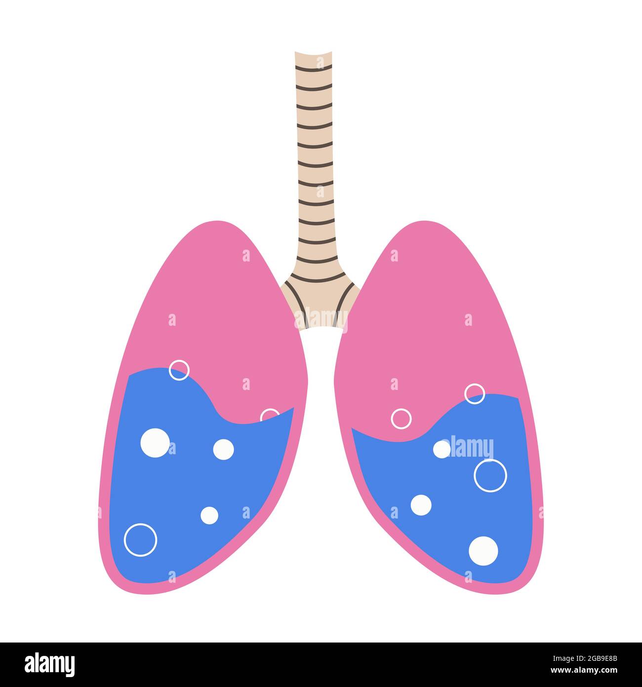 Œdème pulmonaire. Liquide dans les organes respiratoires. Bulles dans