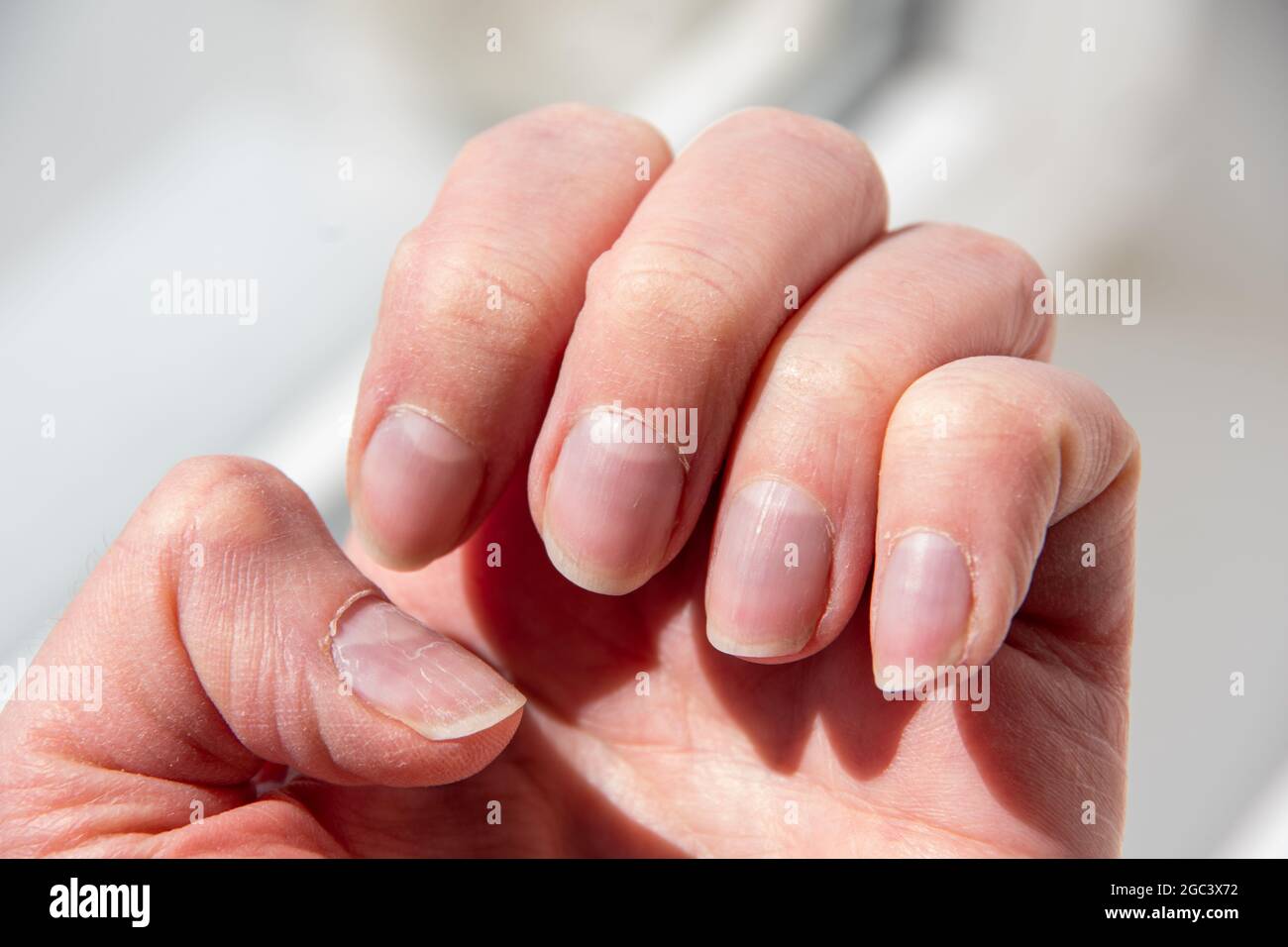 Fermez les ongles de la femme après une mauvaise manucure. Ongles trop gros et plaque à ongles endommagée. Concept de santé et de soins. Banque D'Images