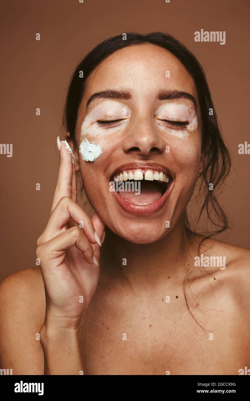 Portrait de la jeune femme avec vitiligo appliquant de la crème sur la joue. Femme gaie avec le vitiligo représentant l'acceptation de soi et la positivité du corps. Banque D'Images
