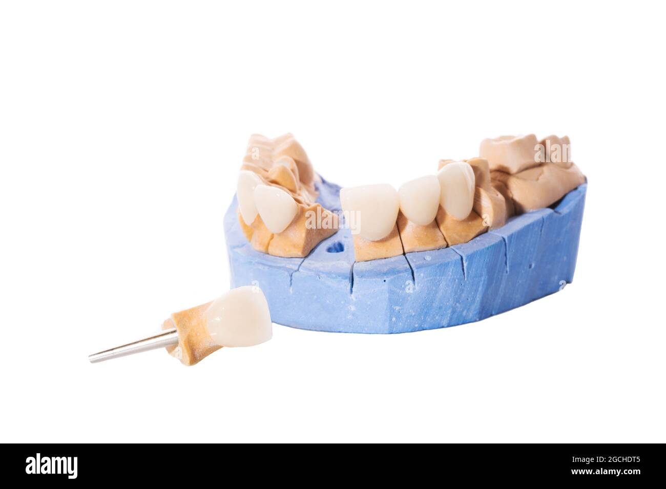 Boiseries et couronnes isolées sur fond blanc. Modèle de plâtre de dents. Modèle de plâtre à mâchoire inférieure avec dents préparées. Fonctionnement du mode de plâtre démontable Banque D'Images