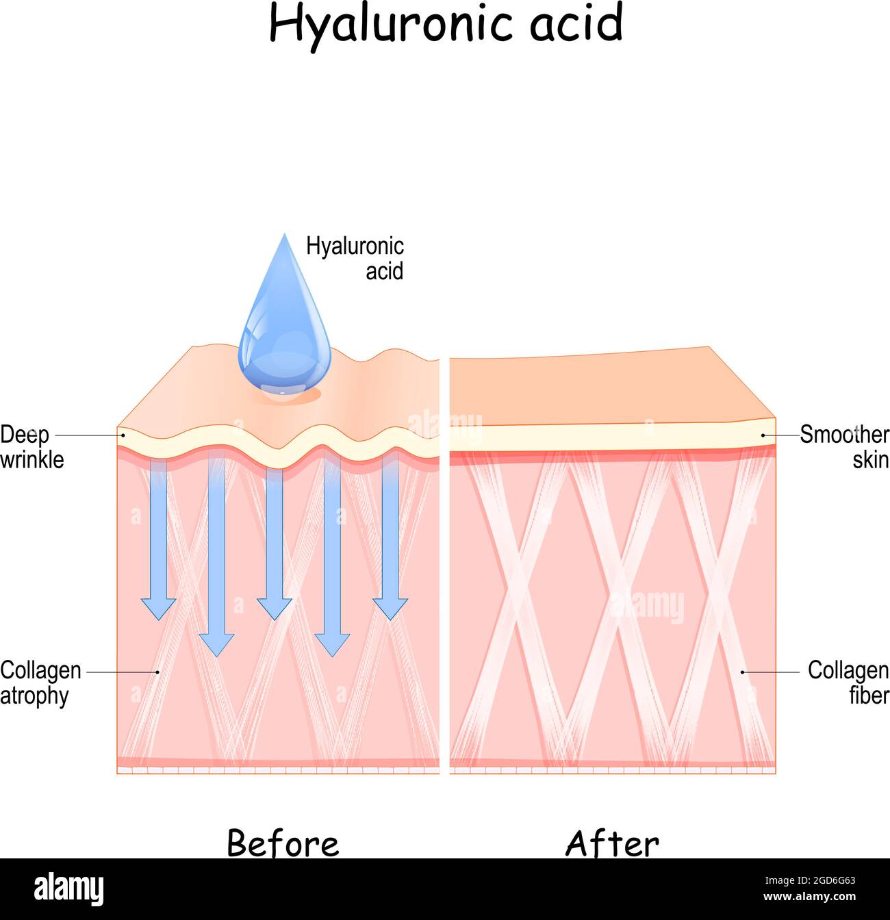 Acide hyaluronique. Peau avant et après l'utilisation de l'acide hyaluronique. Comparaison et différence entre la peau et l'atrophie du collagène Illustration de Vecteur
