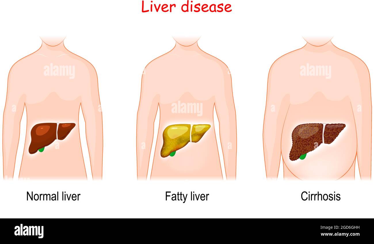 Maladies du foie. Stades de lésions hépatiques. Sain, gras, et cirrhose. Corps humain avec des organes internes éclairés sains et malades. Vecteur Illustration de Vecteur