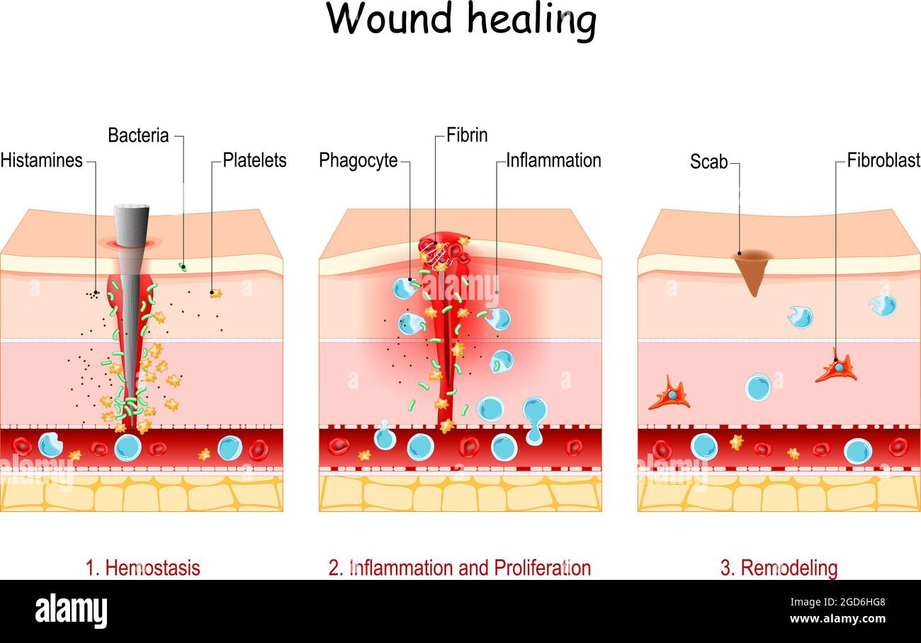 cicatrisation des plaies. Étapes du processus de réparation posttrauma