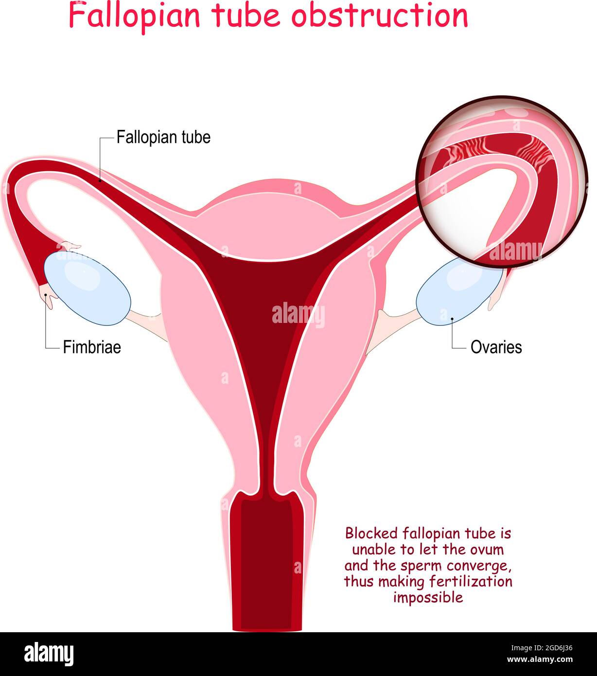 Obstruction de la trompe de Fallope. Coupe transversale de l'utérus avec les ovaires, fimbriae. Gros plan de la trompe de Fallope bloquée qui ne peut pas laisser l'ovule Illustration de Vecteur