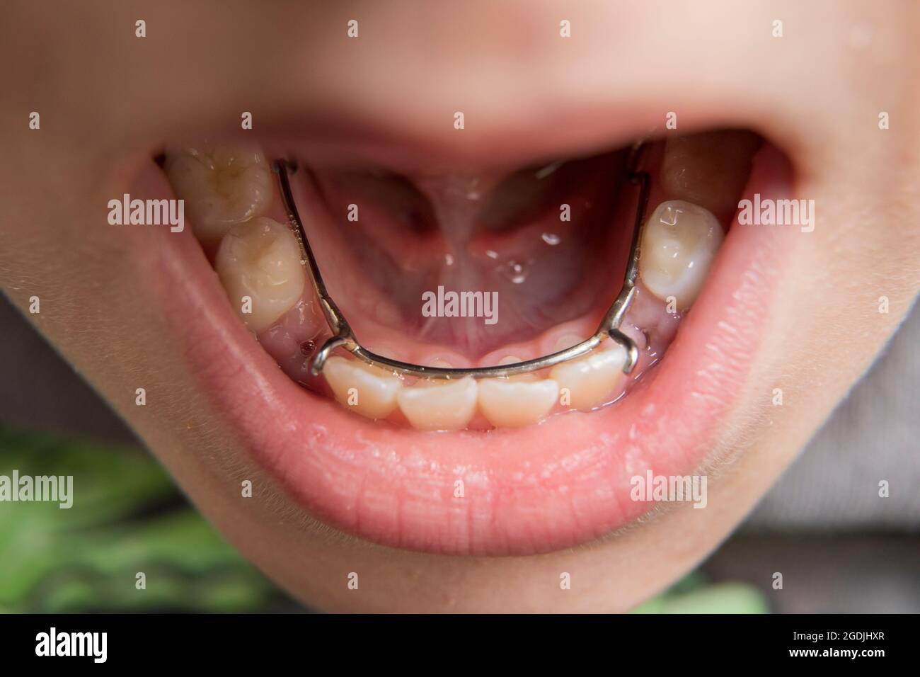 jeune garçon ayant un agent de maintenance de l'espace dentaire dans sa bouche Banque D'Images
