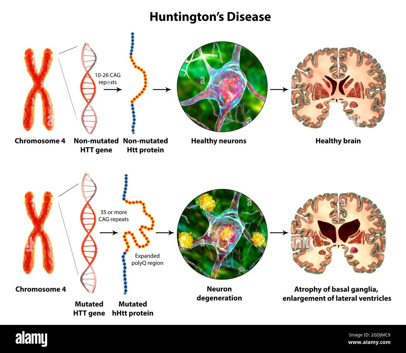 Genèse moléculaire de la maladie de Huntington, illustration 3D Banque D'Images