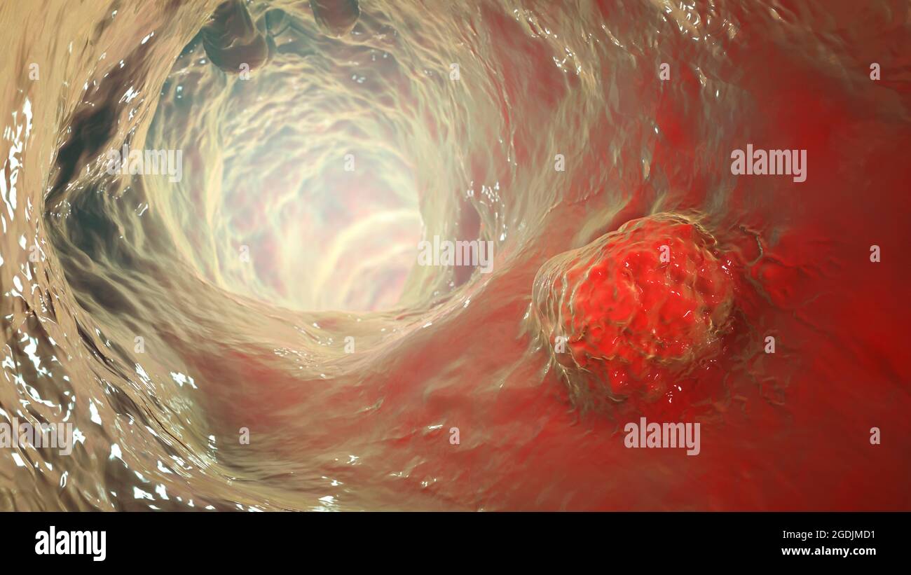 Carcinome intestinal, illustration Banque D'Images