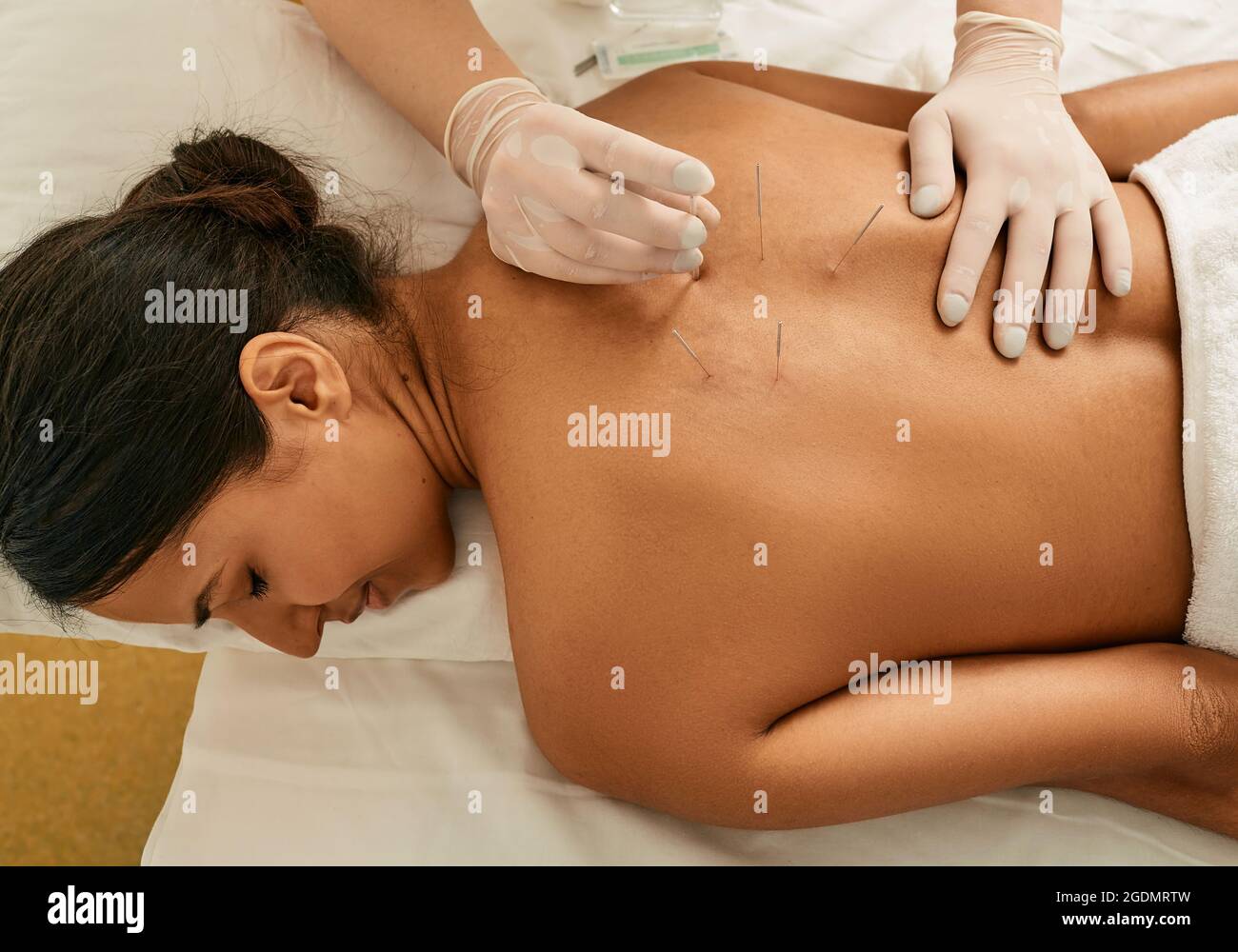 Acupuncture pour le dos d'une jeune femme dans une clinique chinoise. Vue de dessus Banque D'Images