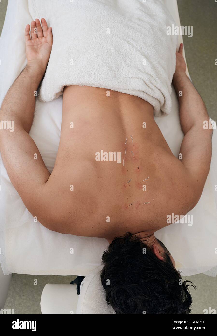 Acupuncture pour le dos d'un homme adulte dans une clinique chinoise. Vue de dessus Banque D'Images