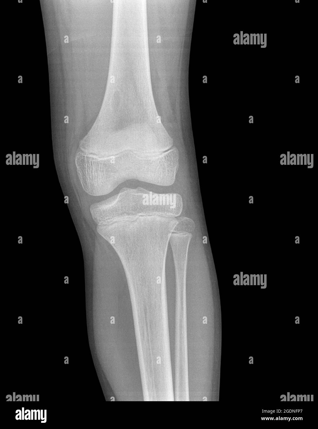 homme de 13 ans avec contusion sur le genou gauche. vue avant. pas de fracture Banque D'Images