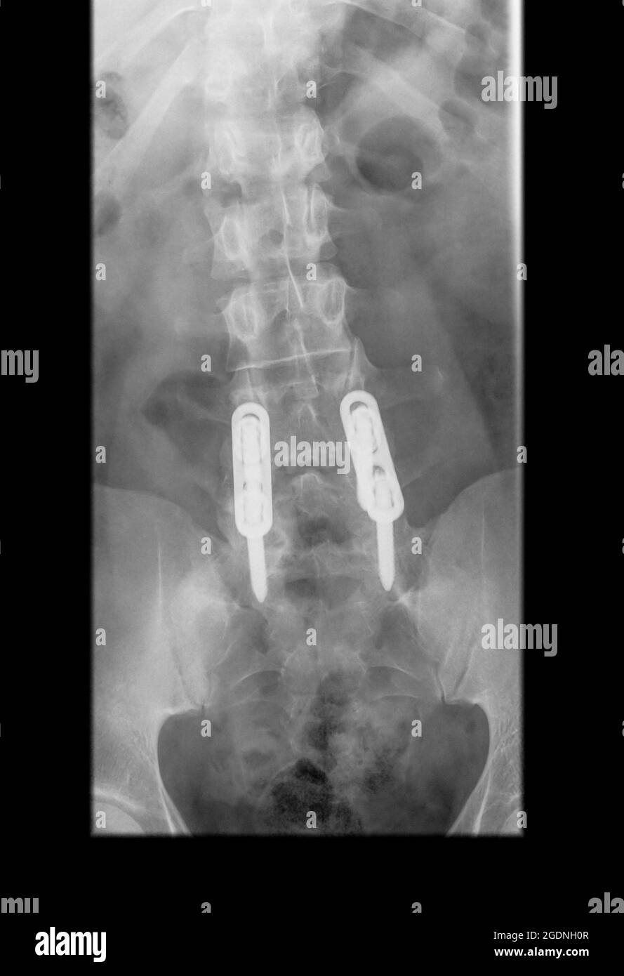 Radiographie d'un homme de 31 ans avec des vis en L4 et L5 pour soulager les douleurs dans le bas du dos Banque D'Images