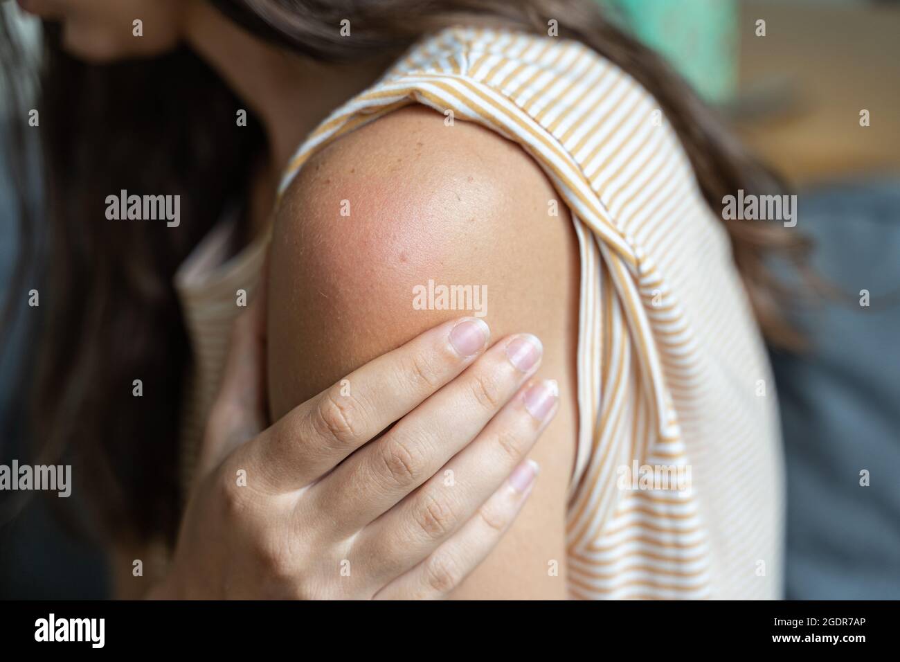 Effet secondaire du vaccin - rougeur et douleur de la peau de l'épaule. Réaction de vaccination Covid-19. La peau de la femme démange et gonfle après la vaccination Banque D'Images